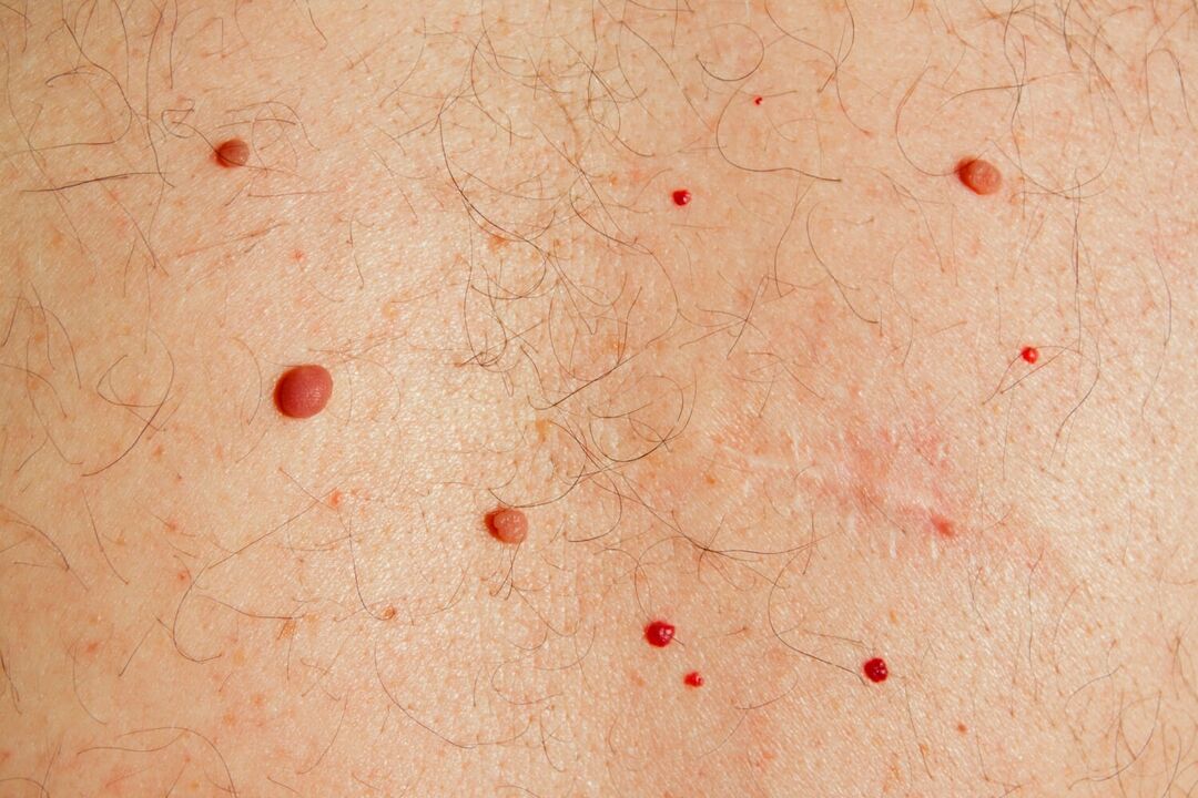 HPV'nin neden olduğu vücutta papillomlar